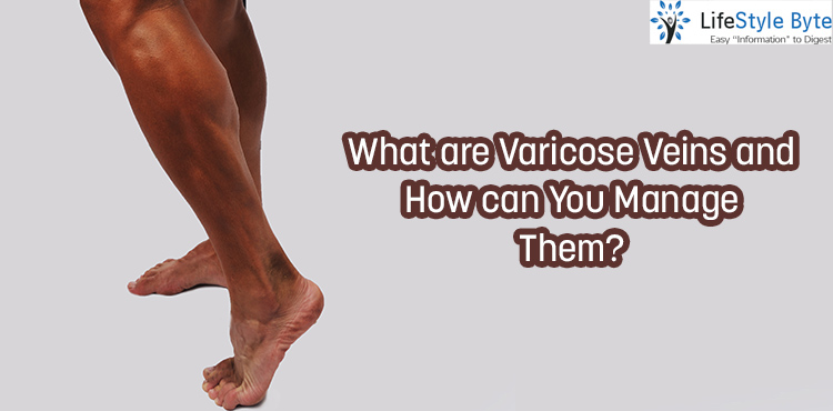 what are varicose veins and how can you manage them?